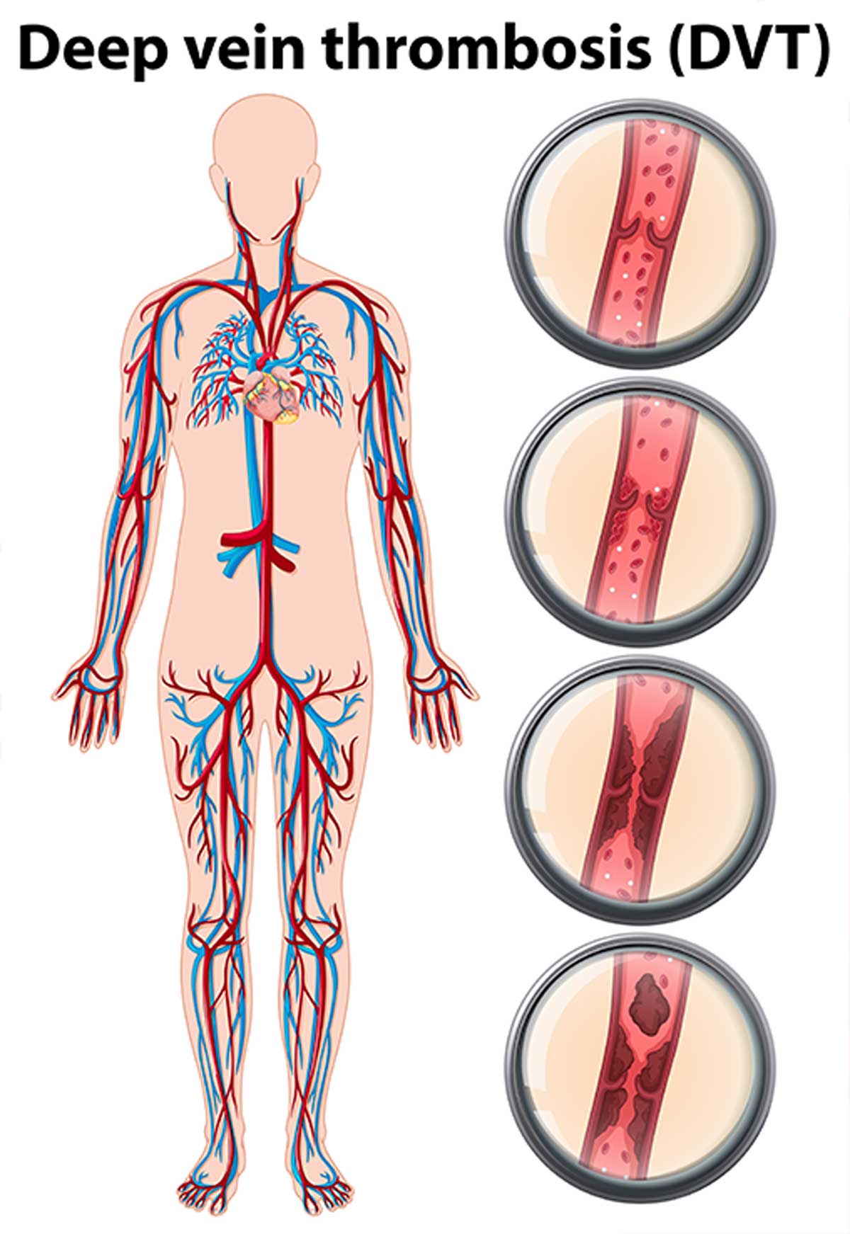 Thrombosis: A Comprehensive Overview