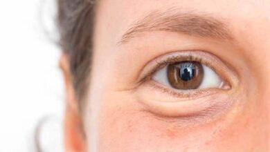 Ways to cure eye puffiness naturally
