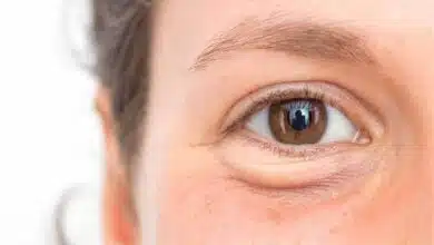 Ways to cure eye puffiness naturally