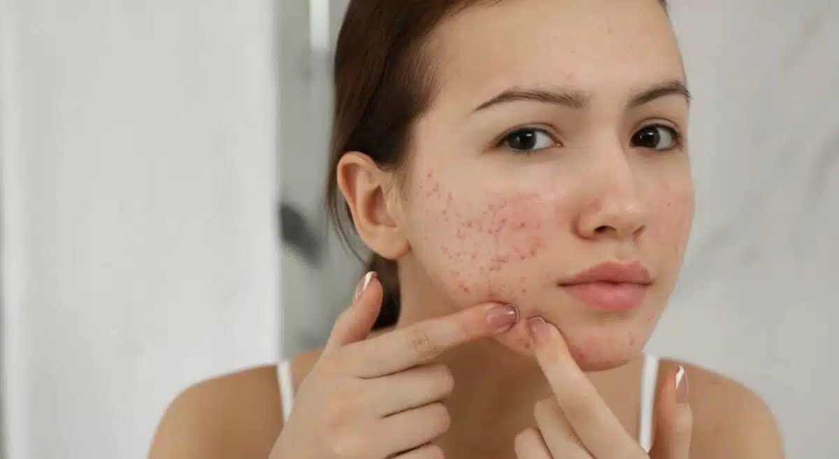 What to apply on the face to remove acne