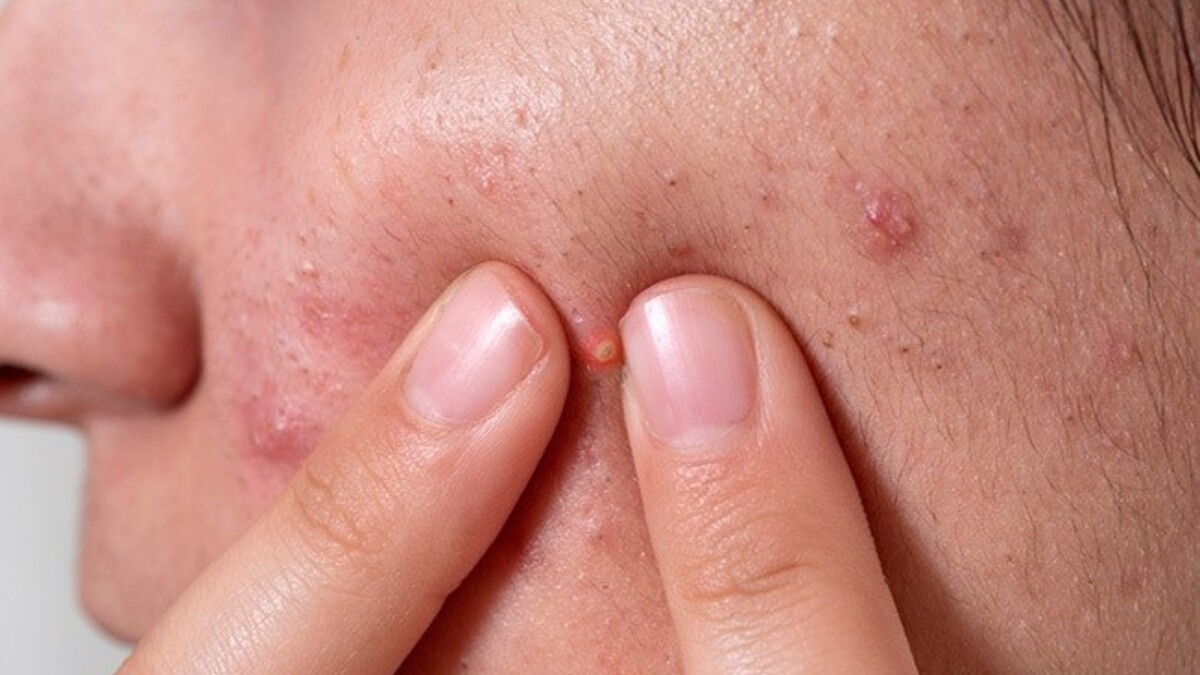 What to apply on the face to remove acne