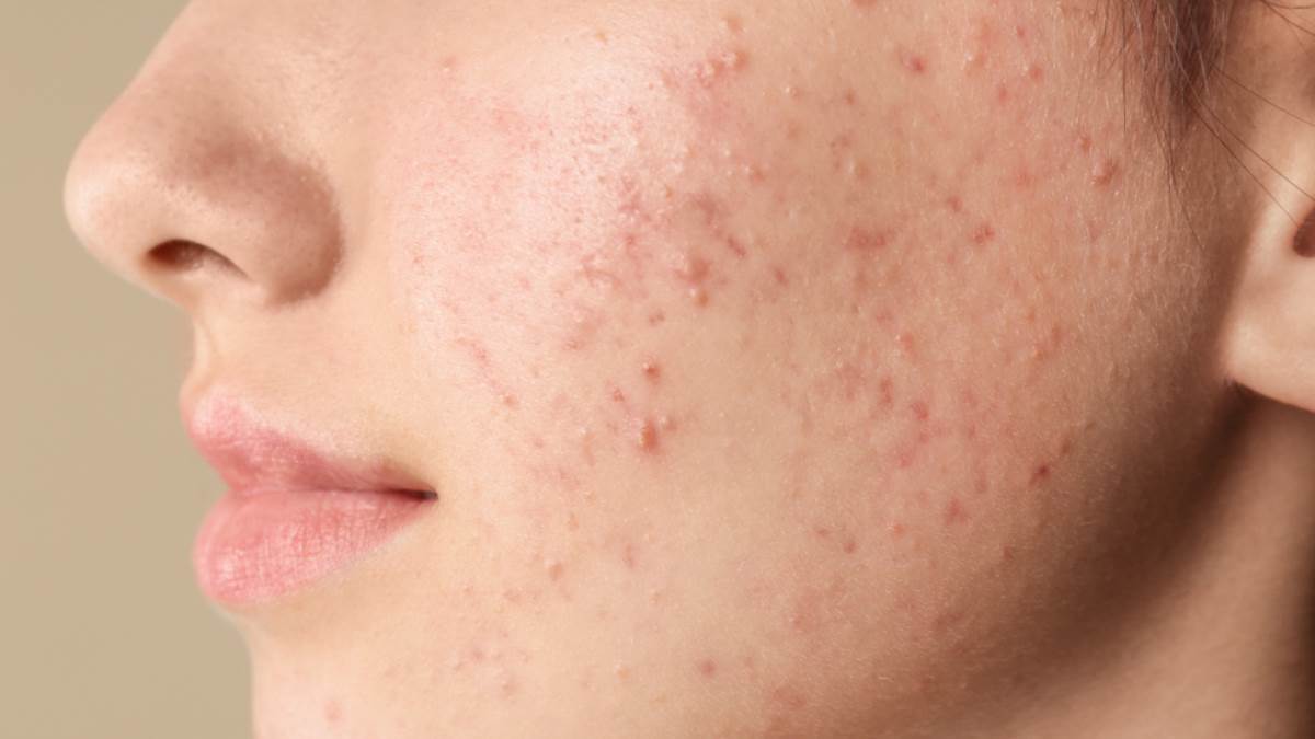 What to apply on the face to remove acne