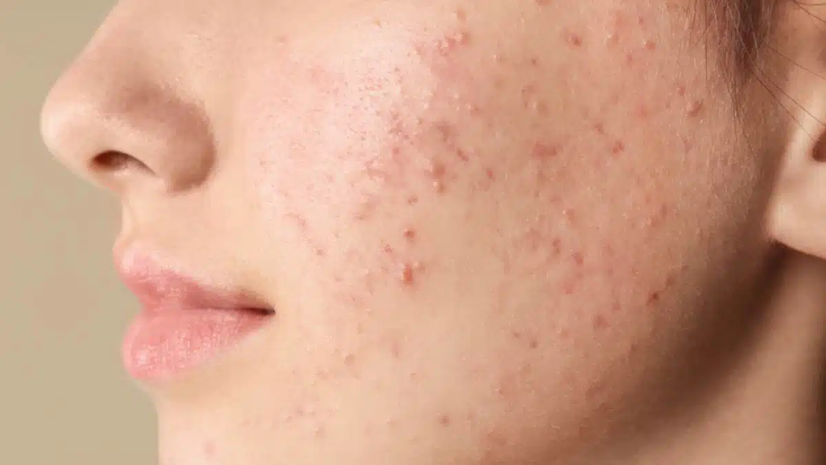 What to apply on the face to remove acne