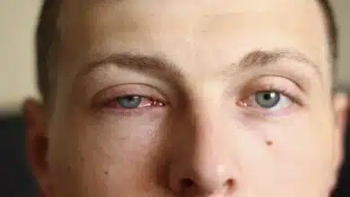 Eye Swelling: 5 Foods That Help Reduce Eye Swelling