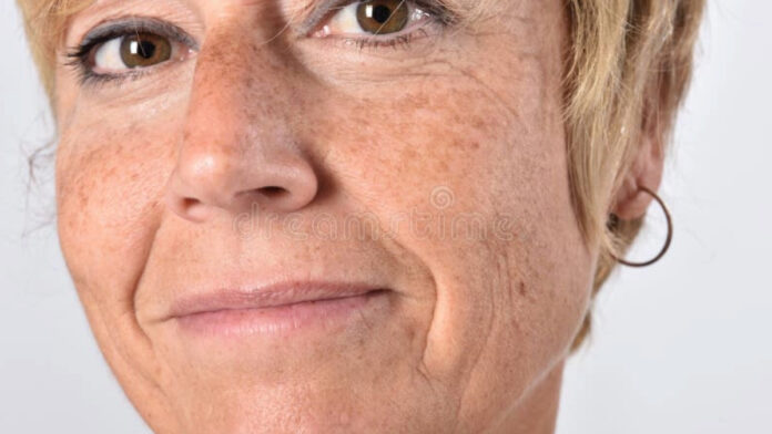 What are freckles? Why do we get freckles?