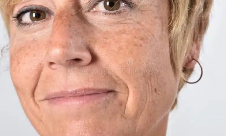 What are freckles? Why do we get freckles?