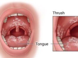 What is thrush, know its causes and types