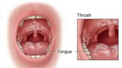 What is thrush, know its causes and types