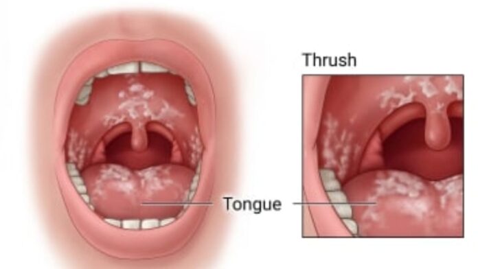 What is thrush, know its causes and types