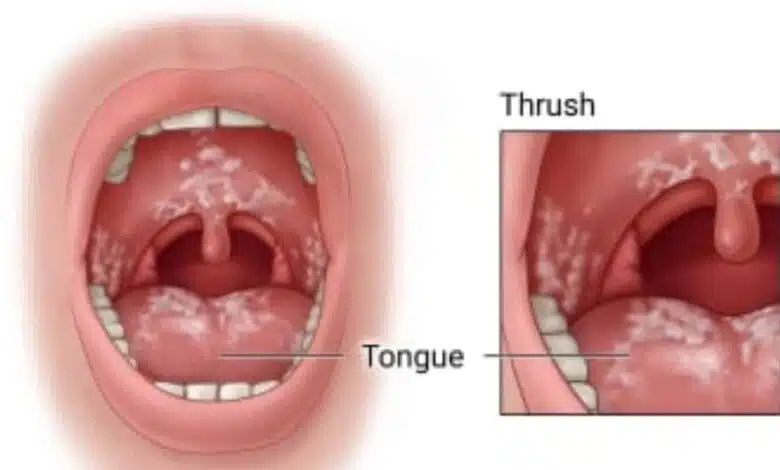 What is thrush, know its causes and types