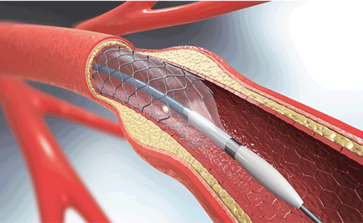 Ways to remove artery blockage