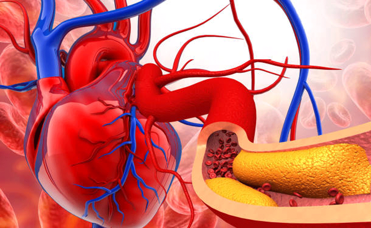 Ways to remove artery blockage