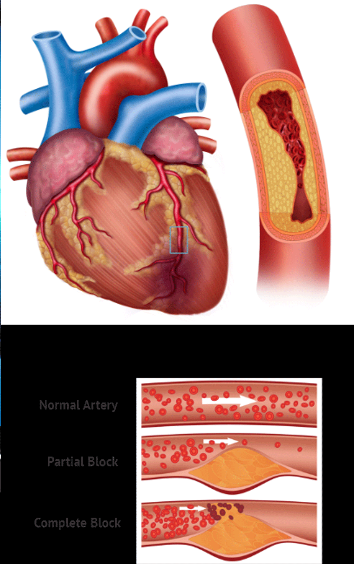 Ways to avoid heart attack