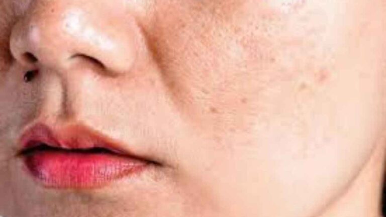 Pigmentation से हैं परेशान तो अपनाएं ये घरेलू तरीके 