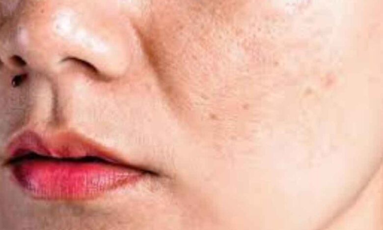 If you are troubled by pigmentation then try these home remedies