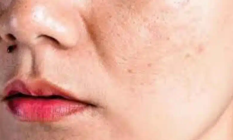 If you are troubled by pigmentation then try these home remedies