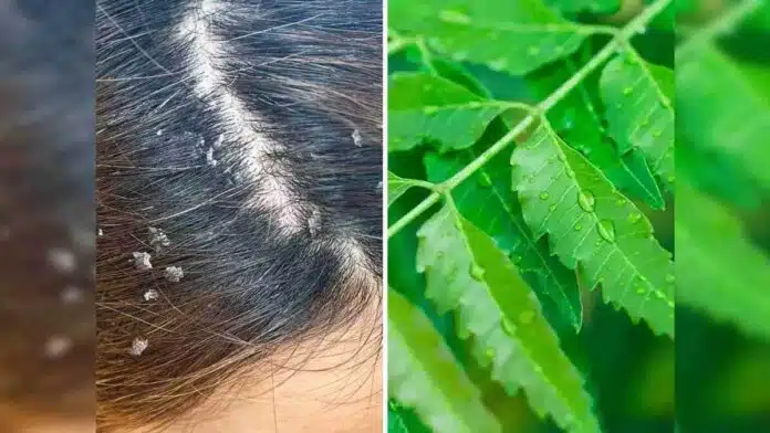 Neem for Dandruff A natural remedy to get rid of it