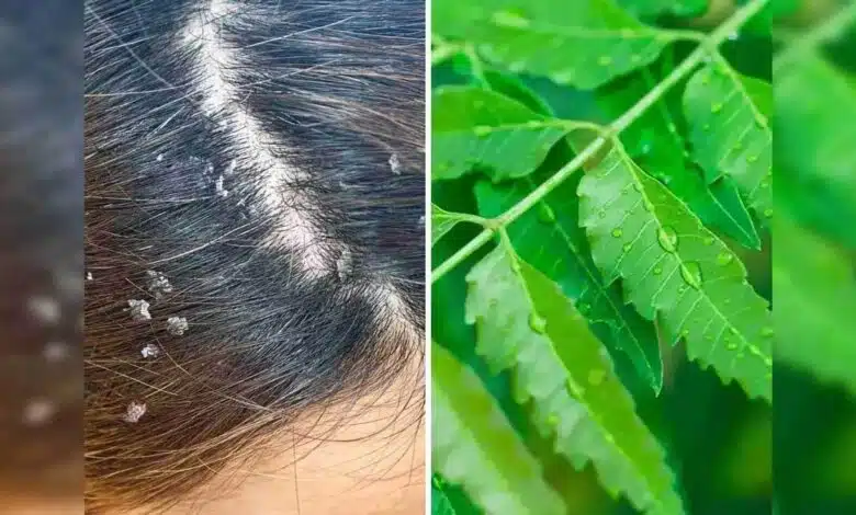 Neem for Dandruff A natural remedy to get rid of it