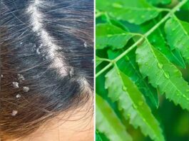 Neem is a natural remedy to get rid of dandruff