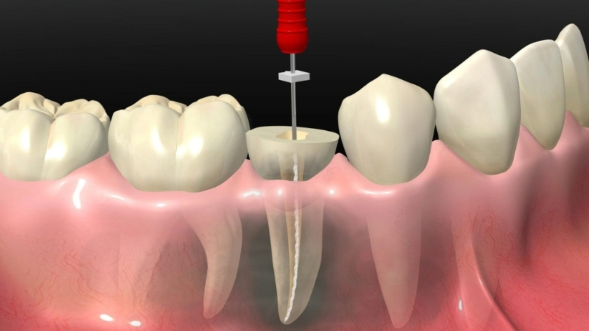 Root canal treatment of teeth