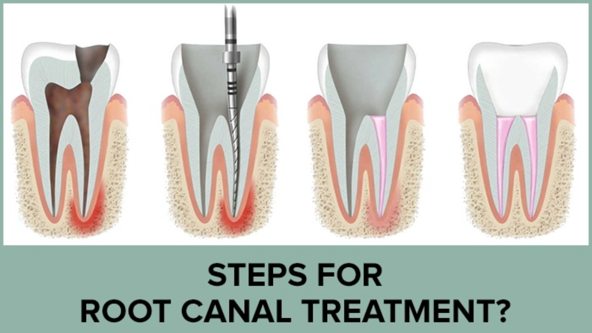 Root canal treatment of teeth