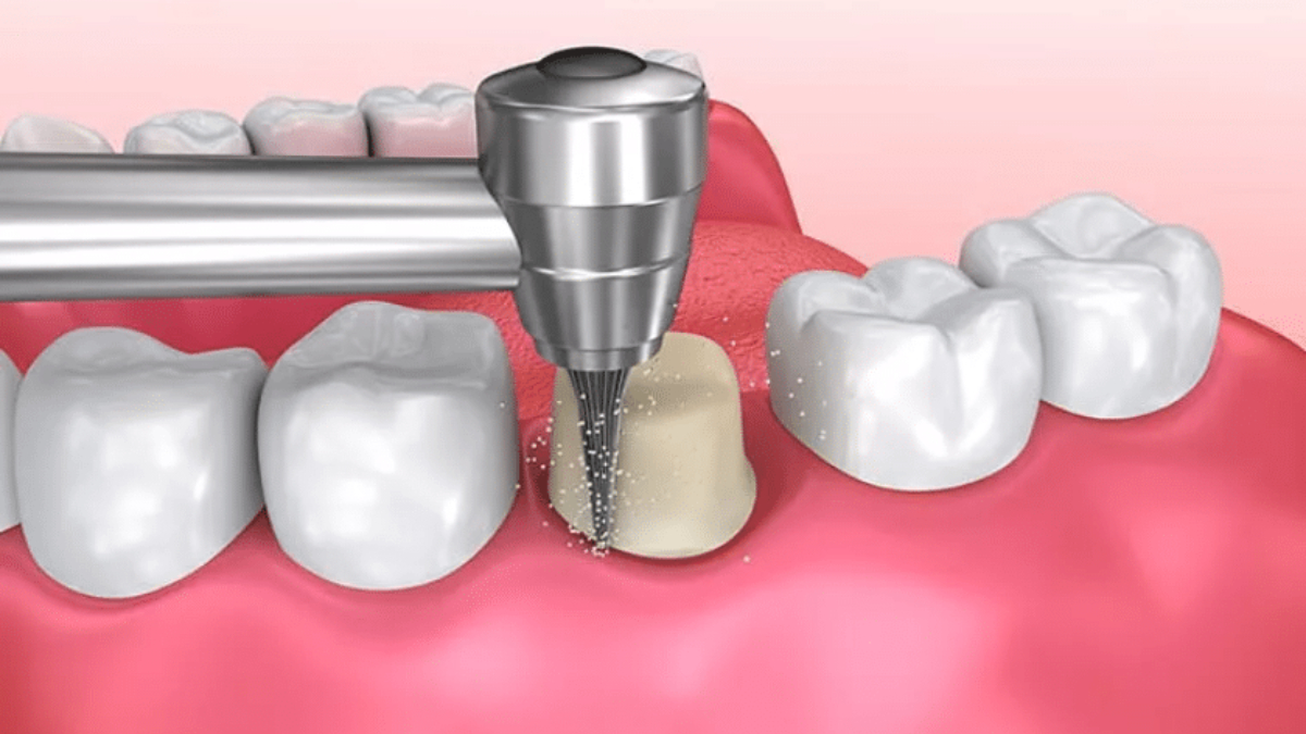 Root canal treatment of teeth