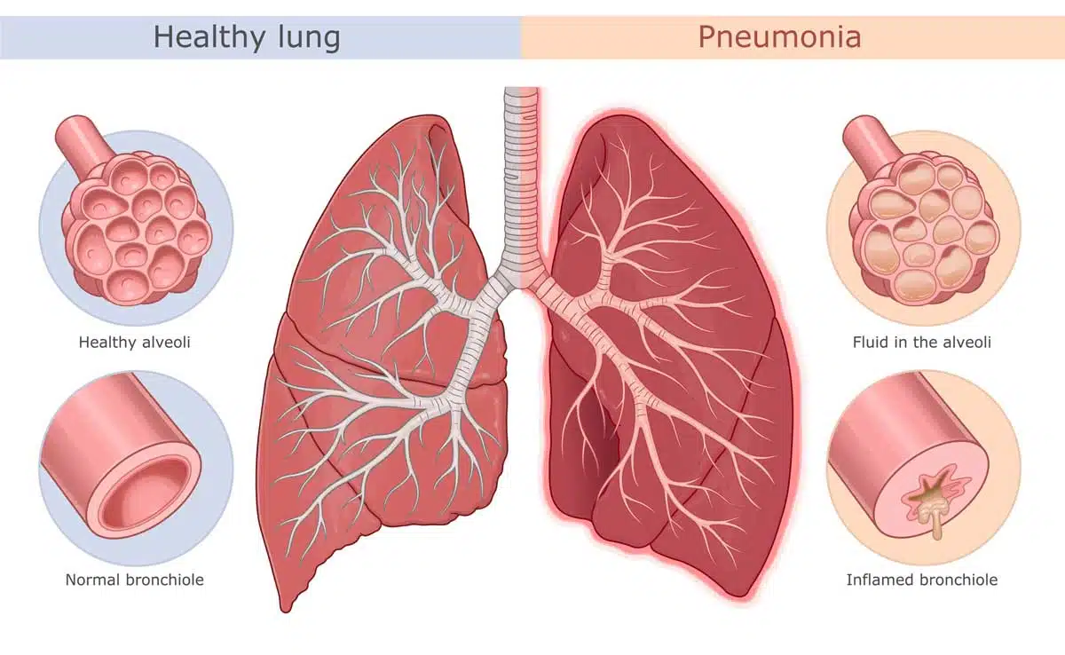 Understanding of Pneumonia in Seniors