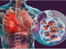 Understanding of Pneumonia in Seniors