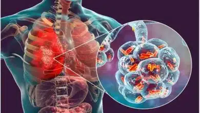 Understanding of Pneumonia in Seniors