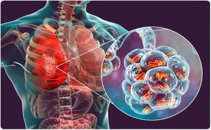 Understanding of Pneumonia in Seniors