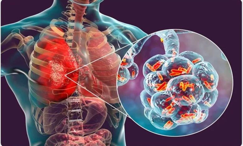 Understanding of Pneumonia in Seniors