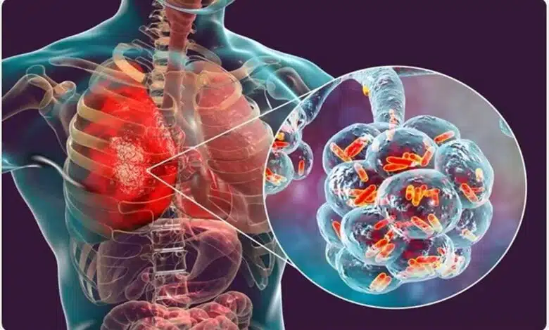 Understanding of Pneumonia in Seniors