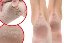 Which vitamin deficiency causes heels to crack