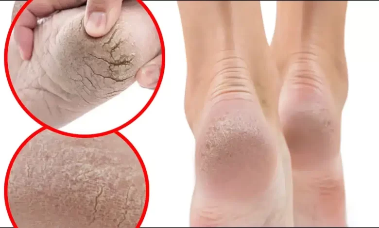 Which vitamin deficiency causes heels to crack
