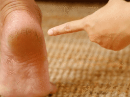 5 home remedies for cracked heels