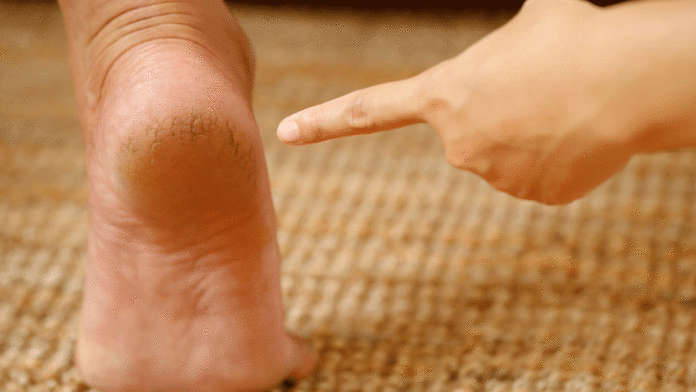 5 home remedies for cracked heels