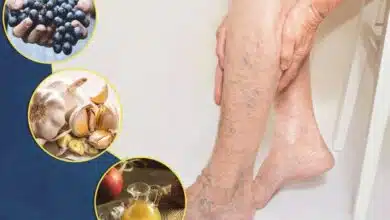 8 Foods That Help With Varicose Veins