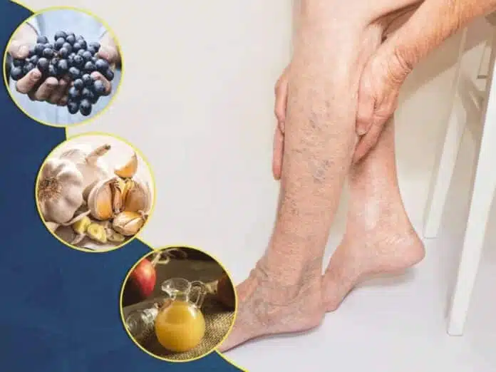 8 Foods That Help With Varicose Veins