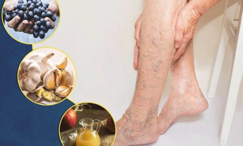 8 Foods That Help With Varicose Veins