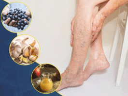 8 Foods That Help With Varicose Veins