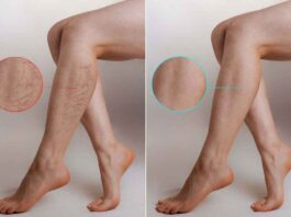 A Comprehensive Introduction to Varicose Veins