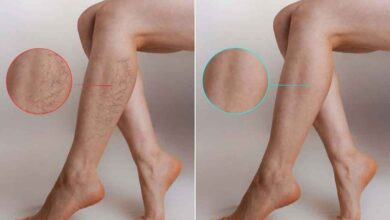 A Comprehensive Introduction to Varicose Veins