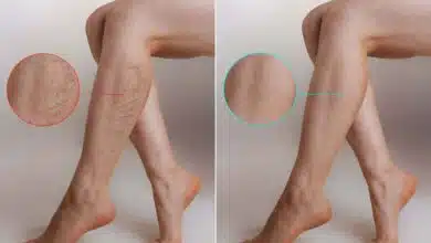 A Comprehensive Introduction to Varicose Veins