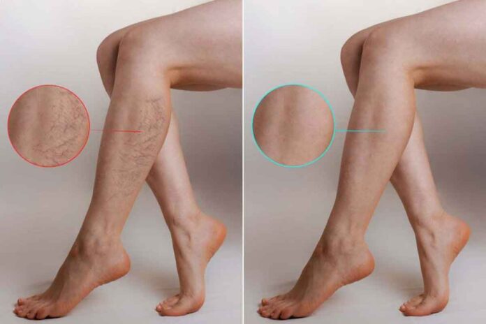 A Comprehensive Introduction to Varicose Veins