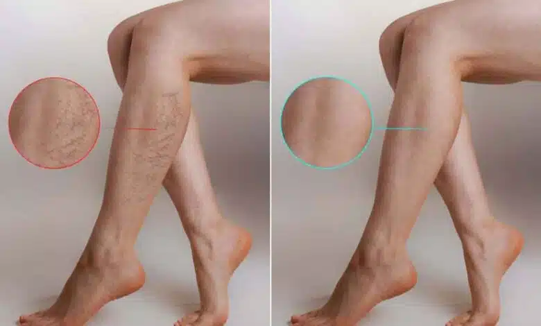 A Comprehensive Introduction to Varicose Veins