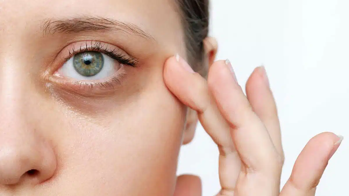 If you are troubled by dark circles, then try these oils to lighten them naturally.