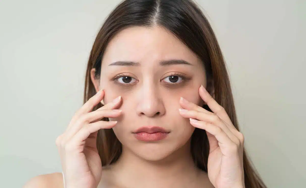 If you are troubled by dark circles, then try these oils to lighten them naturally.