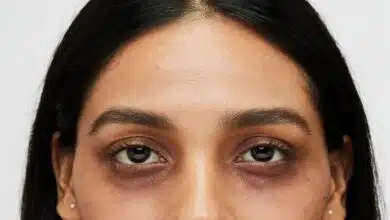 If you are troubled by dark circles, then try these oils to lighten them naturally.
