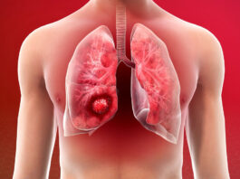 What are the main risk factors for Lung Cancer and how is it treated?