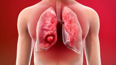 What are the main risk factors for Lung Cancer and how is it treated?